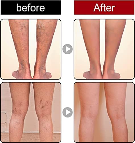 Gel VeinCare 2PCS – Sollievo Vene Varicose e Gambe Pesanti