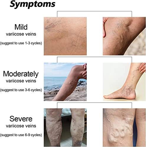 Gel VeinCare 2PCS – Sollievo Vene Varicose e Gambe Pesanti