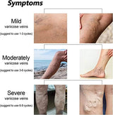 Gel VeinCare 2PCS – Sollievo Vene Varicose e Gambe Pesanti