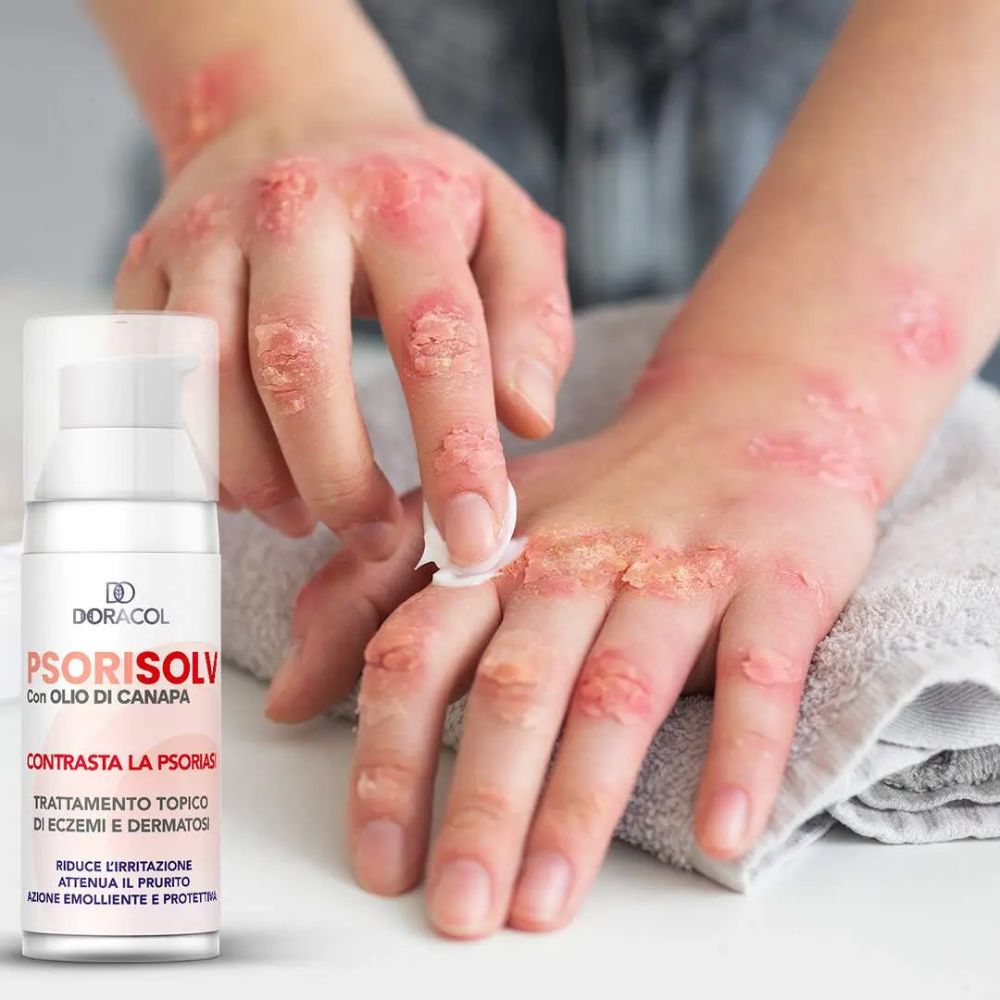 Sorisolv – Psoriasis Cream