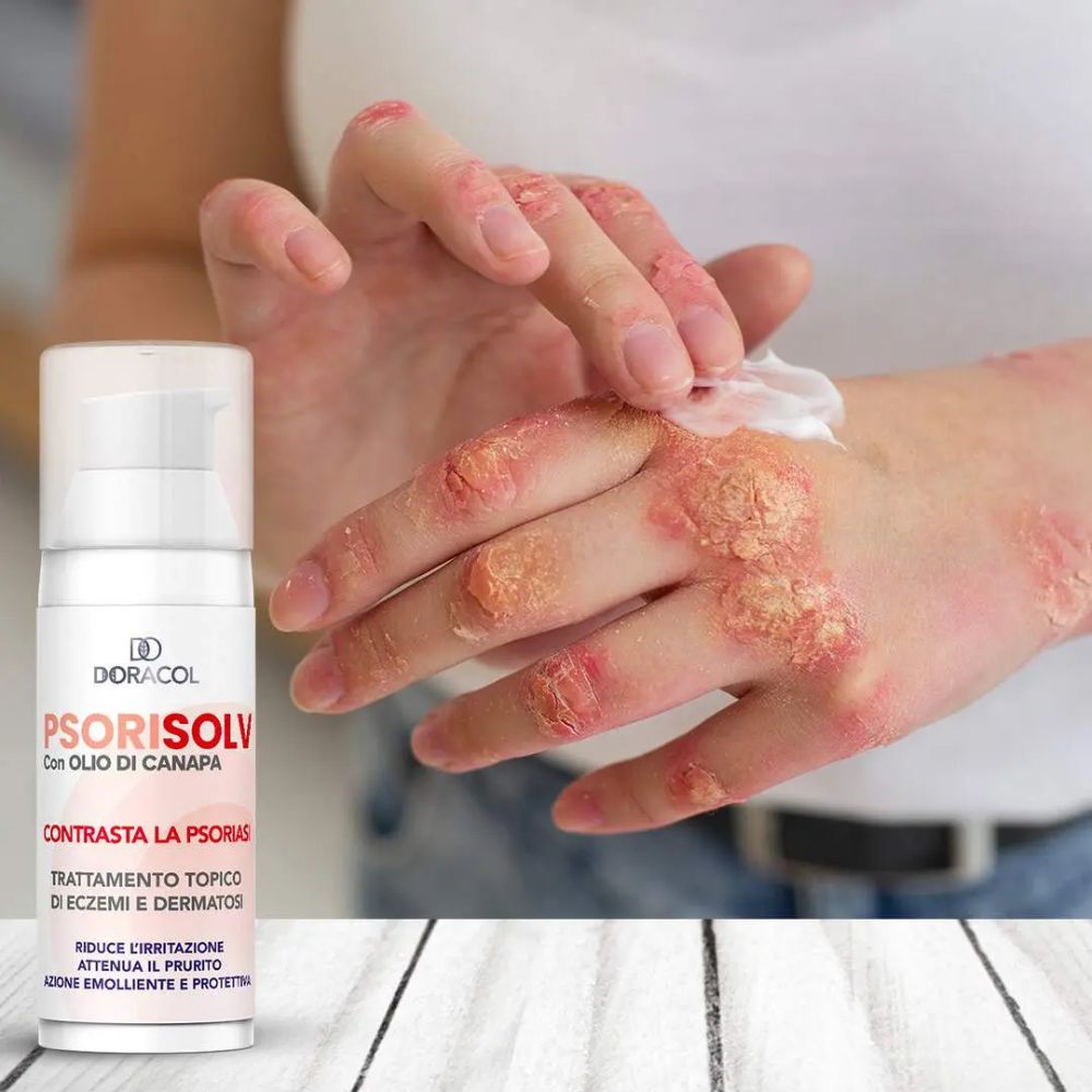 Sorisolv – Psoriasis Cream