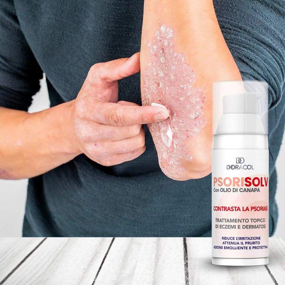 Sorisolv – Psoriasis Cream